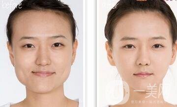 做過顴骨和下顎角手術后的感受