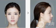 降低顴骨的方法有哪些?術后怎么護理?