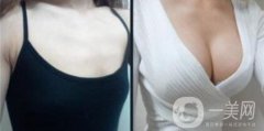 假體隆胸后感覺好嗎