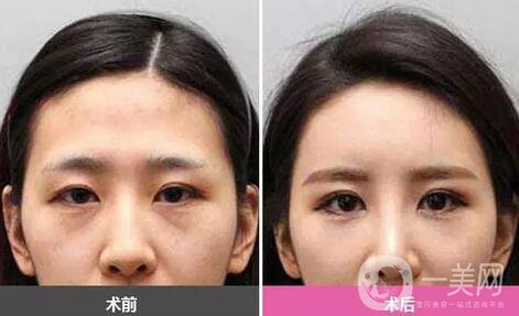 廣東自體脂肪填充淚溝多少錢？