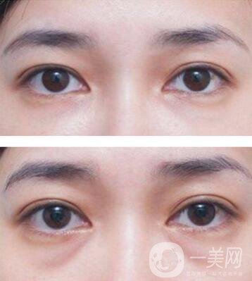 廣東自體脂肪填充淚溝多少錢？