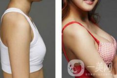 上海假體隆胸的價格高嗎？要多少錢