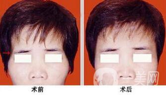 玻尿酸豐太陽穴術(shù)后護(hù)理注意事項有哪些