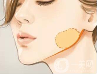 去頰脂墊瘦臉多少錢？