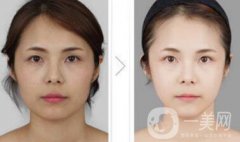 光纖溶脂好不好？價(jià)格是多少