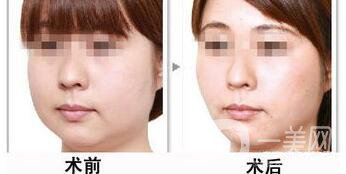 光纖溶脂好不好？?jī)r(jià)格是多少