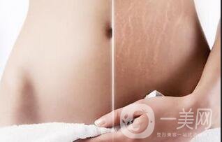 果酸換膚去妊娠紋*果,果酸換膚去妊娠紋多少錢(qián)
