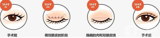 割雙眼皮埋線(xiàn)過(guò)程圖,埋線(xiàn)雙眼皮注意事項(xiàng)