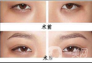 割雙眼皮埋線(xiàn)過(guò)程圖,埋線(xiàn)雙眼皮注意事項(xiàng)