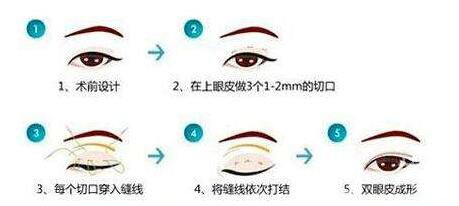 割雙眼皮埋線(xiàn)過(guò)程圖,埋線(xiàn)雙眼皮注意事項(xiàng)