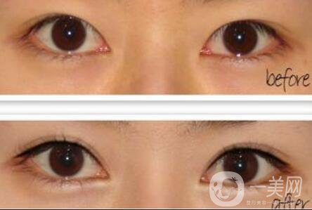 開(kāi)眼角注意事項(xiàng)