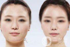 面部光纖溶脂好嗎？價(jià)格是多少