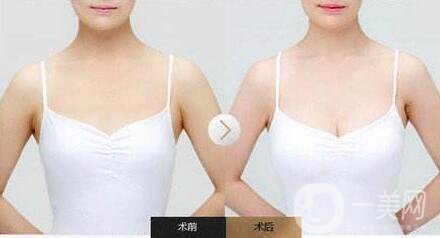 隆胸后怎么護(hù)理？術(shù)前怎么準(zhǔn)備？