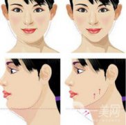 怎么去掉雙下巴？溶脂去雙下巴怎么樣