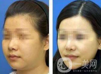怎么去掉雙下巴？溶脂去雙下巴怎么樣