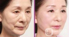 拉皮除皺能堅(jiān)持幾年？與哪些因素有關(guān)？