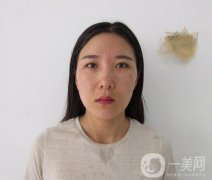 全開雙眼皮和開眼角案例分享，變美就是這么簡單！