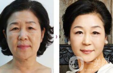 拉皮能維持多久？拉皮的價(jià)格是多少