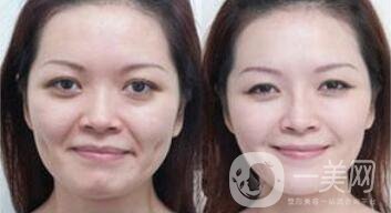 拉皮能維持多久？拉皮的價(jià)格是多少