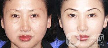 拉皮能維持多久？拉皮的價(jià)格是多少