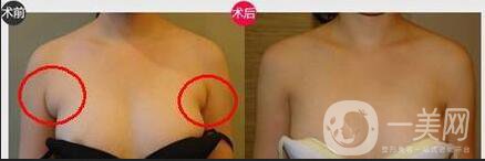 副乳祛除價格,副乳祛除術后護理