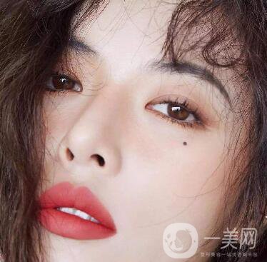 玻尿酸去眉間紋多少錢及術后護理