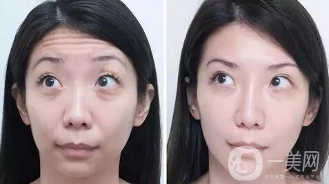 玻尿酸去眉間紋多少錢及術后護理