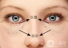深圳臥蠶整形價(jià)格是多少？