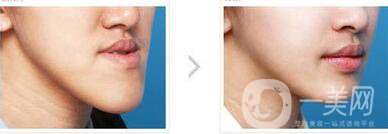 北京天包地矯正多少錢