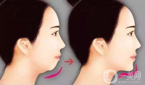 膨體墊下巴有沒有后遺癥？有些什么后遺癥