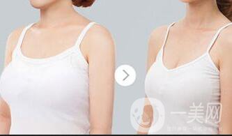 上?？s乳手術(shù)多少錢,縮乳手術(shù)多少錢