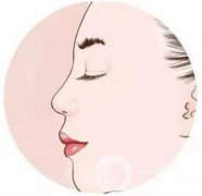 北京駝峰鼻矯正手術(shù)費用大概有多少