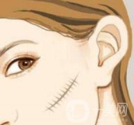 激光祛疤果怎么樣？有什么優(yōu)勢
