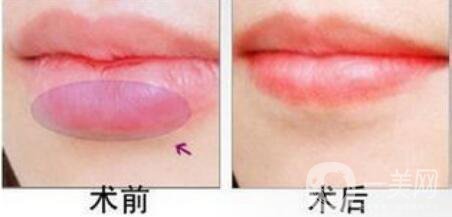 厚唇改薄,厚唇改薄多久見(jiàn)*,厚唇改薄圖