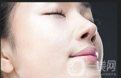 激光去胎記會反彈嗎 激光去胎記注意事項