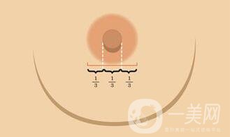 深圳乳頭縮小費用