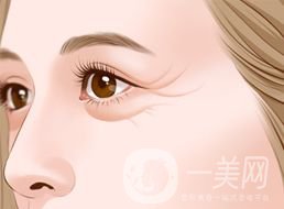 上海自體脂肪去魚尾紋多少錢呢？