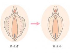 陰唇整形不良后果有哪些？