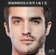 胡須種植注意事項(xiàng)有哪些？