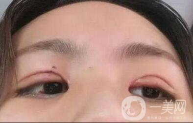 像素激光祛痘坑術(shù)后護理工作主要做些什么