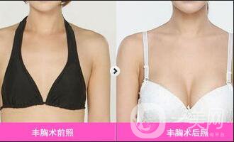 乳房再造整形手術價格