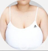 巨乳縮小術(shù)貴嗎？巨乳縮小多少錢？