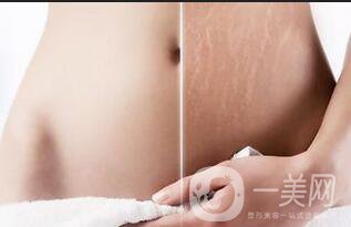 去妊娠紋價格