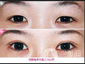 開眼角風(fēng)險