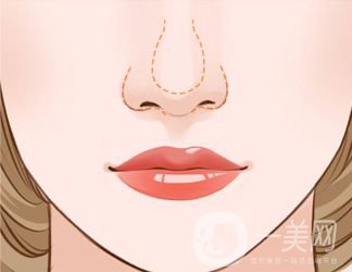 鼻翼縮小價(jià)錢(qián)