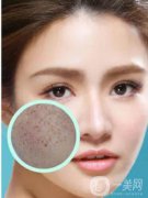 長(zhǎng)了黃褐斑怎么辦 光子嫩膚調(diào)節(jié)黃褐斑價(jià)格是多少？