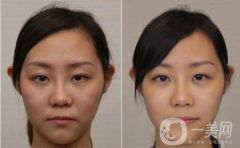 拉皮是不是可以除皺 拉皮除皺果怎么樣
