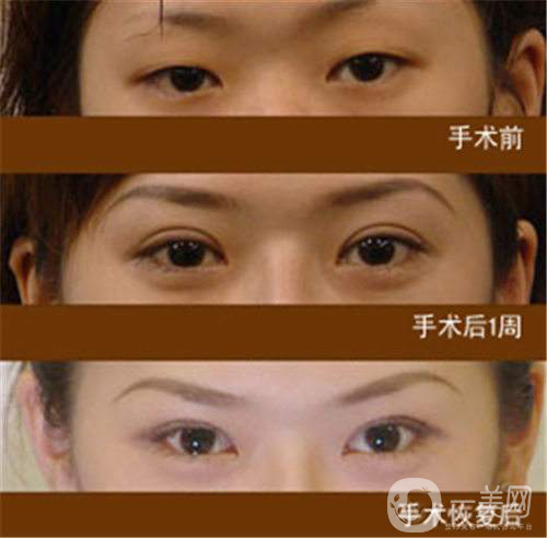生物焊接雙眼皮多少錢(qián)？*果怎么樣？