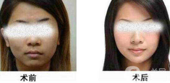 黑臉娃娃縮小毛孔多少錢？