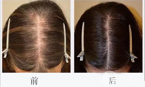 植發(fā)做完會出現(xiàn)后遺癥嗎 植發(fā)護(hù)理方法